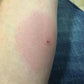 brown recluse spider bites hurt terribly, Kure it Rx Bible Healing Oil helps.