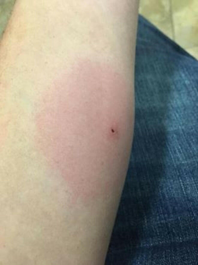 brown recluse spider bites hurt terribly, Kure it Rx Bible Healing Oil helps.