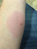 brown recluse spider bites hurt terribly, Kure it Rx Bible Healing Oil helps.