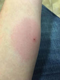 brown recluse spider bite, These hurt terribly. Good thing Kure-it Rx helps with this too.
