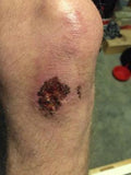 Knee injury helped by using Good Samaritan healing oil