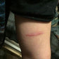 Leg burn from a hot torch, helped by Good Samaritan oil