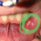 Toothache and infection healed with kure it