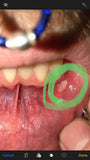 Toothache and infection healed with kure it
