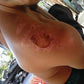 2nd degree burn on shoulder, helped by a Good Samaritan oil