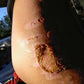 Fast Wound healing with Kure it Bible Healing Oils.