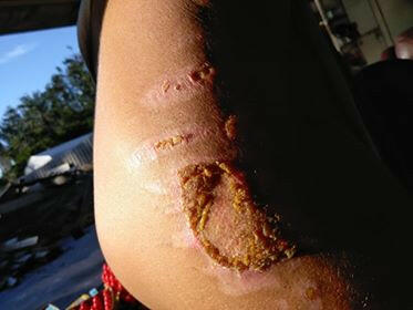 Fast Wound healing with Kure it Bible Healing Oils.