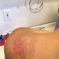 Week 3 3rd degree burn using Good Samaritan Oil